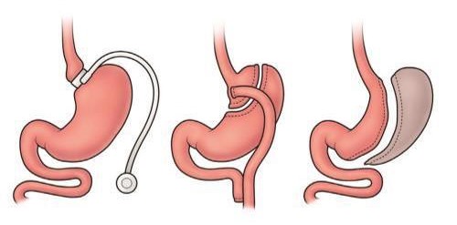 My Decision To Go For Bariatric&nbsp;Surgery